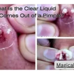 What Is the Clear Liquid That Comes Out of a Pimple