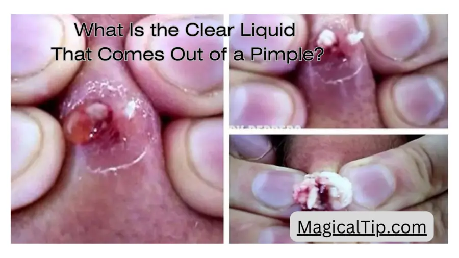 What Is the Clear Liquid That Comes Out of a Pimple